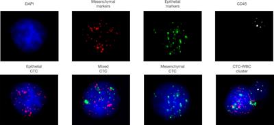 Correlation Between Circulating Tumor Cell DNA Genomic Alterations and Mesenchymal CTCs or CTC-Associated White Blood Cell Clusters in Hepatocellular Carcinoma